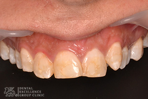 Stained or Discolored tooth 5