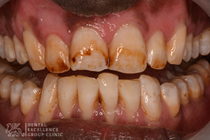 Stained or Discolored tooth 3