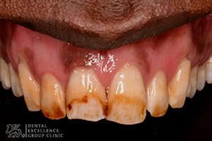 Stained or Discolored tooth 2